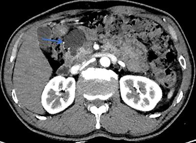 A model for predicting degree of malignancy in patients with intraductal papillary mucinous neoplasm